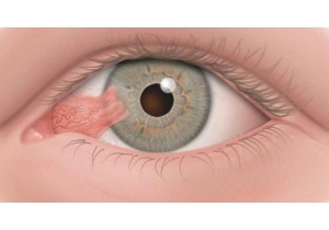 Удаление птеригиума на глазу