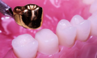 Коронка зуба цельнолитая (без слепков, фиксации, ретракции)