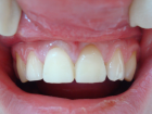 Временная металлопластмассовая коронка зуба (без слепков, фиксации, ретракции)