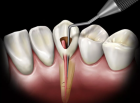 Лечение пульпита трехканального зуба зуба в одно посещение