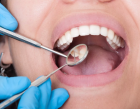 Лечение пульпита двухканального  зуба в два-три посещения