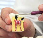 Лечение пульпита трехканального  зуба в два-три посещения