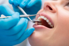 Лечение периодонтита трехканального  зуба в два-три посещения