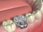 Восстановление зуба металлической коронкой