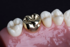 Металлическая коронка на зуб