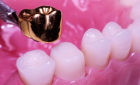 Металлическая зубная коронка с напылением