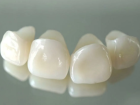 Металлокерамические коронки на передние зубы