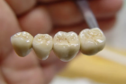 Восстановление зуба металлокерамической коронкой