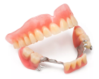 Протезирование зубов бюгельным протезом