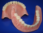 Протезирование зубов полными съемными пластиночными протезами одна челюсть