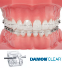 Ортодонтическое лечение с применением самолигирующей брекет системой Damon Clear 