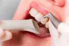 Гигиеническая чистка зубов 