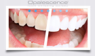 Профессиональное безламповое отбеливание зубов Opalescense Boost