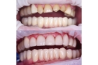Художественная реставрация жевательной группы зубов композитным материалом 
