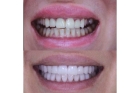 Коронки на верхние зубы