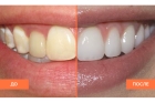 Художественная реставрация фронтальной группы зубов
