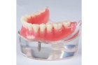 Фиксация съемных зубных протезов