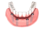 Несъемный протез на 6 зубов