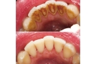 Ультразвуковая чистка 1 зуба