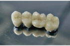 Металлокерамика коронка на зуб