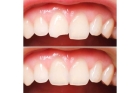 Восстановление формы зуба 