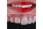 Композитная реставрация зуба 
