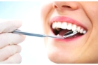 Реставрация эмали зуба 