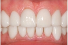 Реставрация боковых зубов 