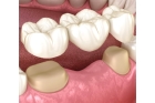 Мостовидный протез зубов