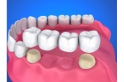 Мостовидный зубной протез 