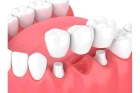 Зубной мост на 3 зуба 