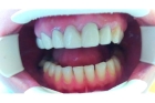 Зубной мост 5 зубов 