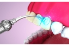 Чистка зубов ультразвуком 