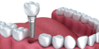Установка зубных имплантов на передние зубы