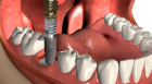 Установка зубных имплантов один зуб