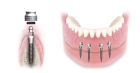 Установка зубных имплантов нижних зубов