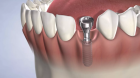 Установка зубных имплантов жевательных зубов