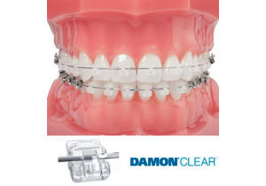 Ортодонтическое лечение с применением самолигирующей брекет системой mini Damon (одна челюсть)