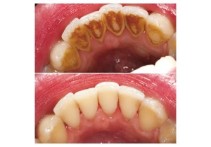 Ультразвуковая чистка 1 зуба