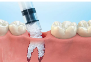 Костная имплантация зубов
