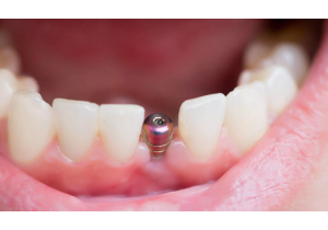 Одномоментная имплантация зубов под ключ