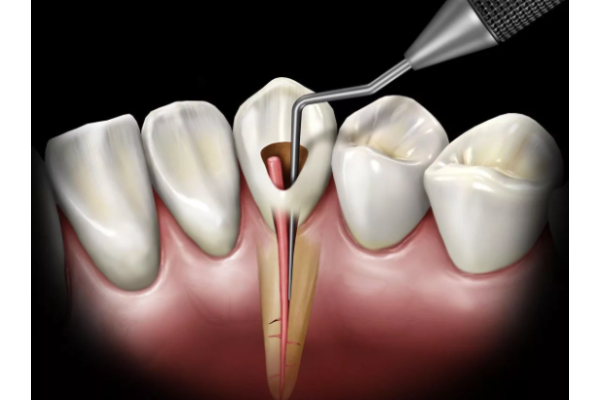 Лечение пульпита трехканального зуба зуба в одно посещение