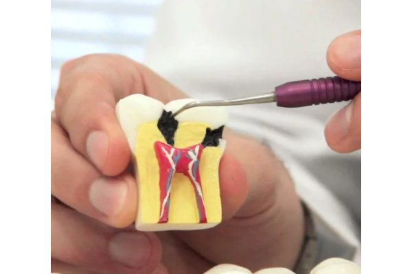 Лечение пульпита одноканального  зуба в два-три посещения