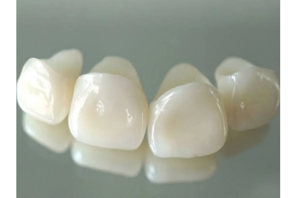 Металлокерамические коронки на передние зубы