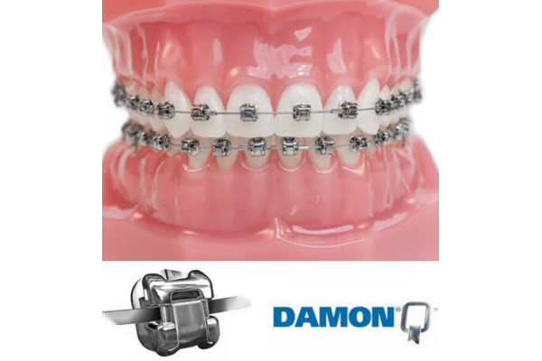 Ортодонтическое лечение с применением самолигирующей брекет системой Damon Q (одна челюсть)