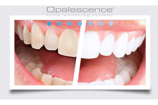 Профессиональное безламповое отбеливание зубов Opalescense Boost