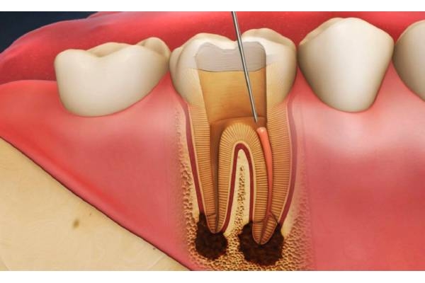 Лечение пульпита 4 зуба