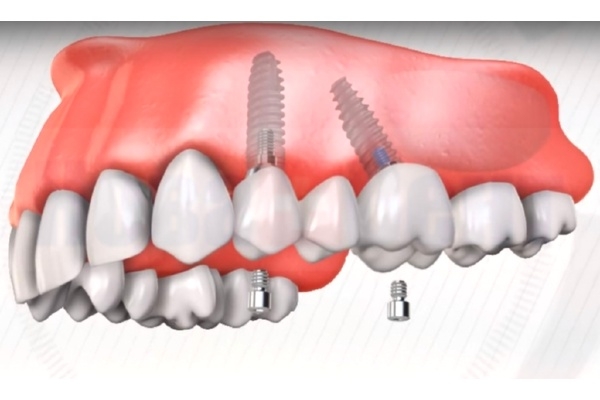 Протезирование зубов на импланте  