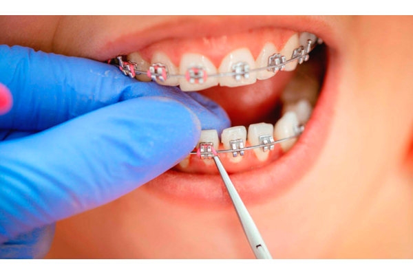 Снятие брекет-системы (с одного зубного ряда) 