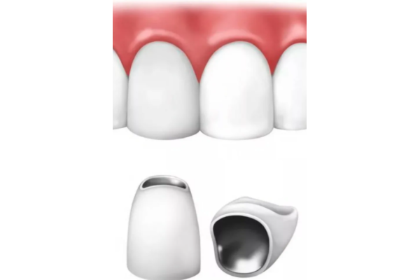 Металлокерамика коронка на передний зуб